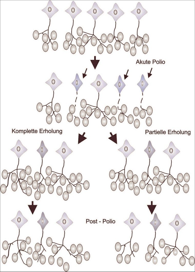 Pathophysiologie des PPS